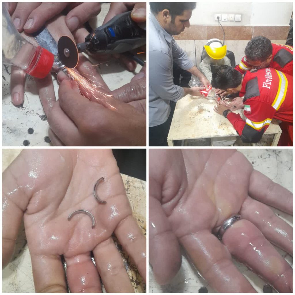 رهاسازی انگشت دست یک خانم ۲۶ ساله از درون انگشتر دردسر ساز توسط ناجیان ۱۲۵